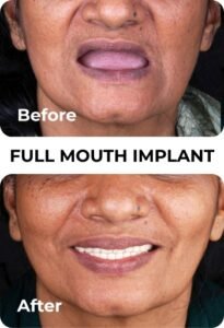 before after 1