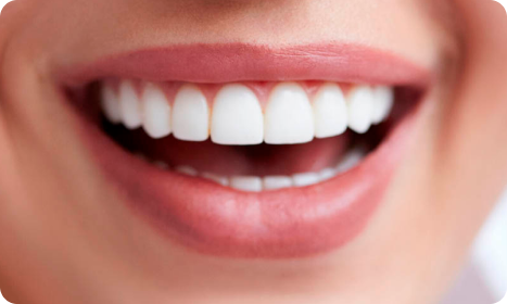 Dental veneers