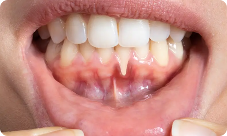 Gum Consultation