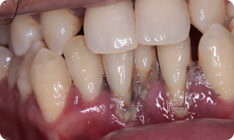 Gum Solutions