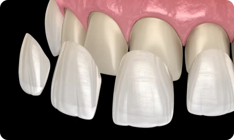 Veneers care