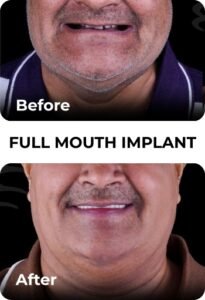 full mouth before after 3