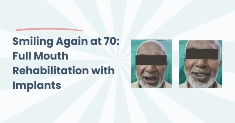 Full Mouth Rehabilitation with Implants