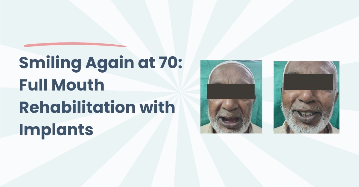 Smiling Again at 70: Full Mouth Rehabilitation with Implants