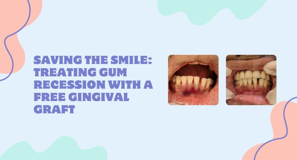 Gum Recession with a Free Gingival Graft