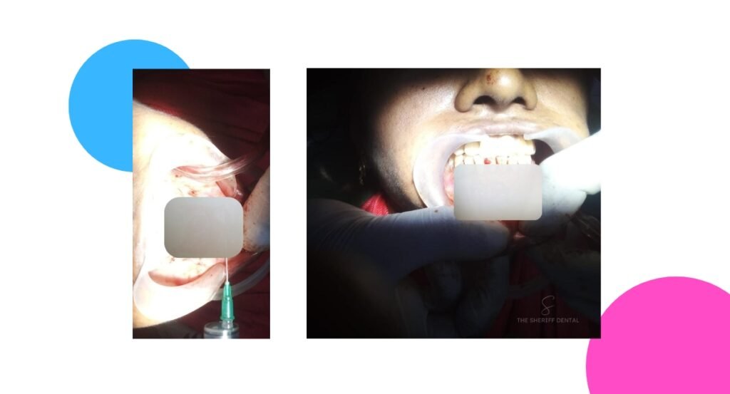 Surgical Cyst Enucleation case study