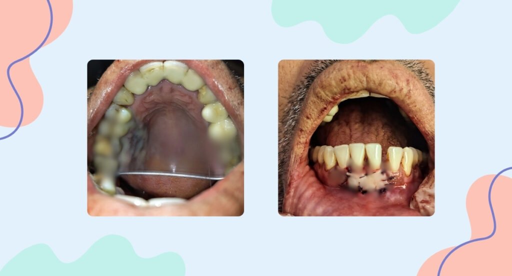 gingival graft
