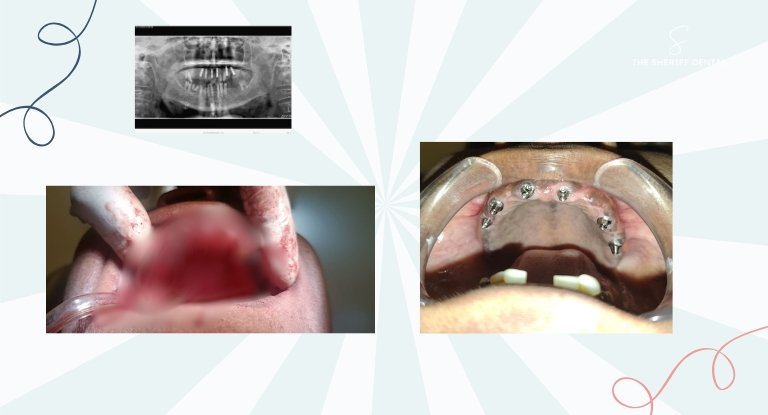 implants were placed in the upper jaw